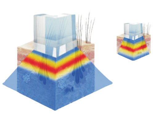 LASER DE DIODO CONVENCIONAL